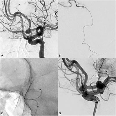 Single-Center Experience With the Bare p48MW Low-Profile Flow Diverter and Its Hydrophilically Covered Version for Treatment of Bifurcation Aneurysms in Distal Segments of the Anterior and Posterior Circulation